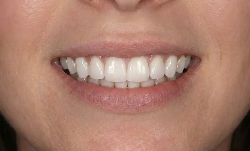 Uśmiech po leczeniu