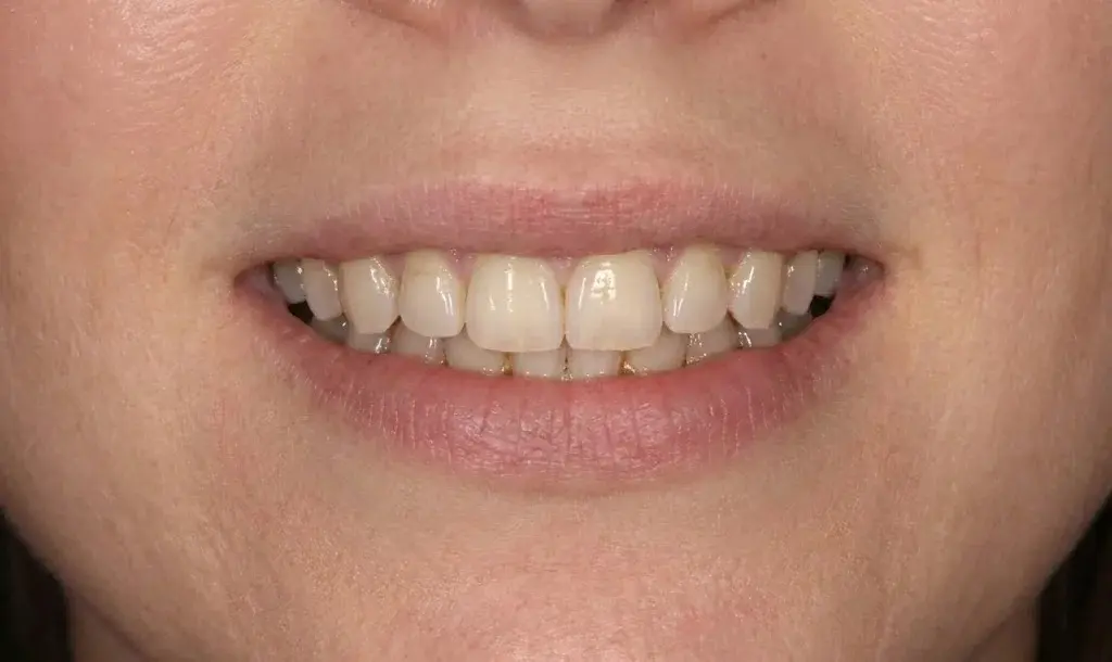 Uśmiech przed leczeniem